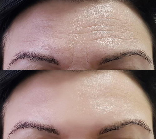 Botox-rides-grenoble-woodward