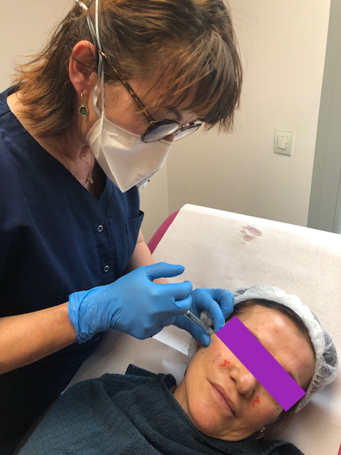 injection-dermato-esthetique-grenoble-woodward